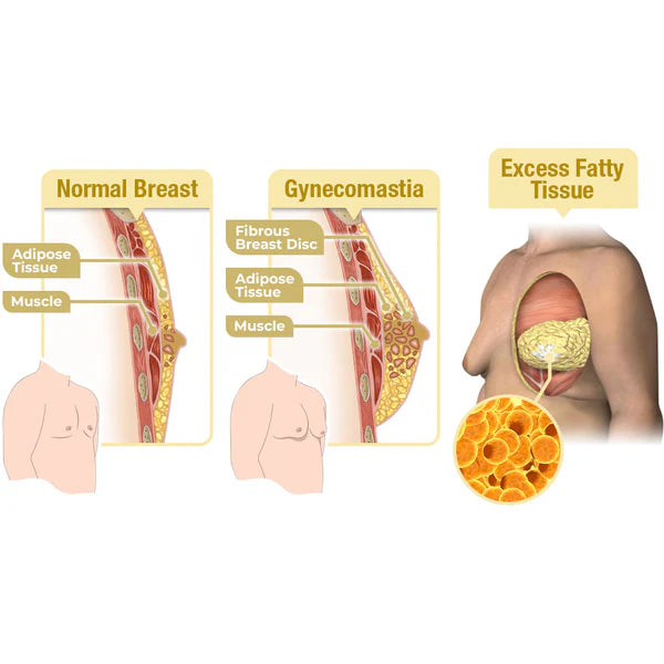 MenTherm Bee Venom Gynecomastia Heating Oil